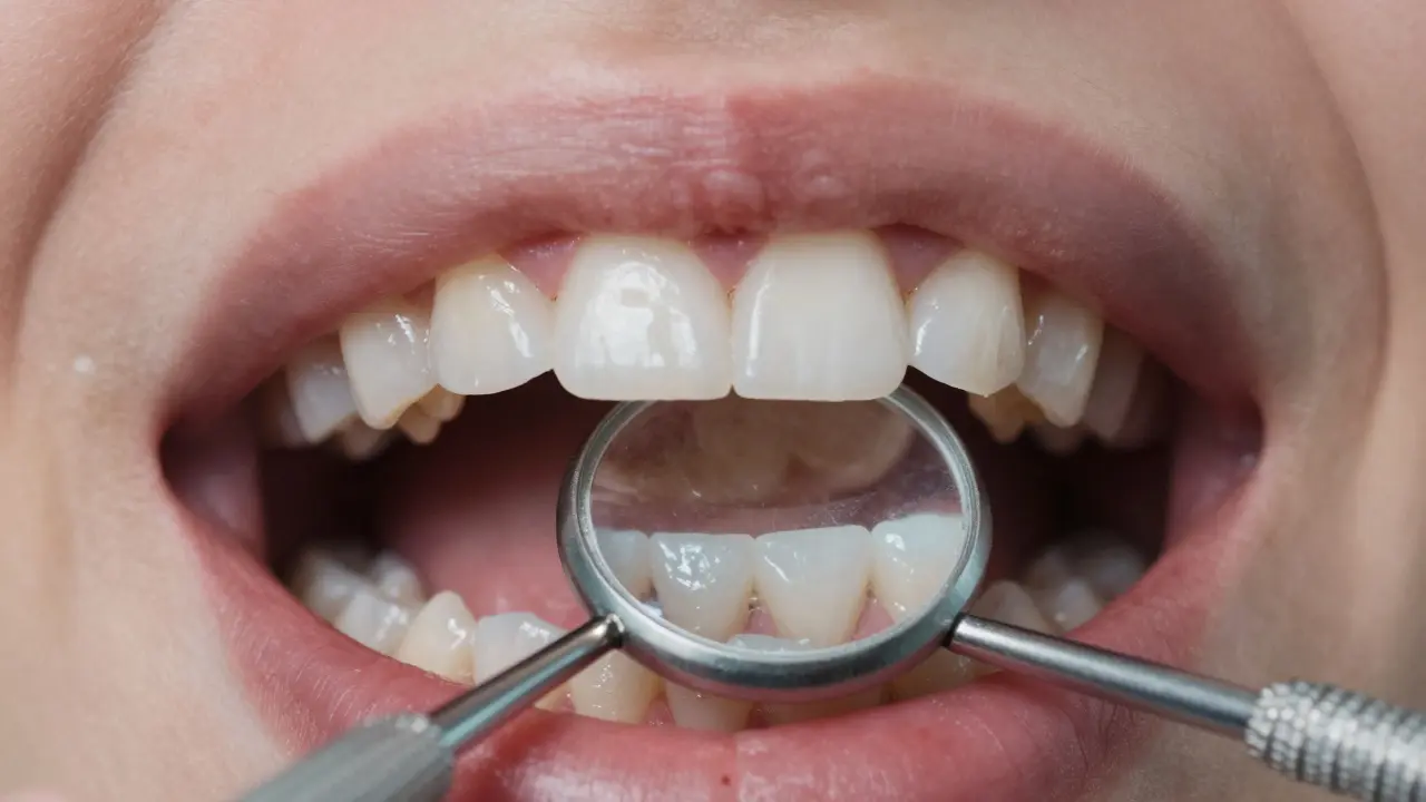 Zuby po odstranění rovnátek s bílými skvrnami pod zbytky zámků