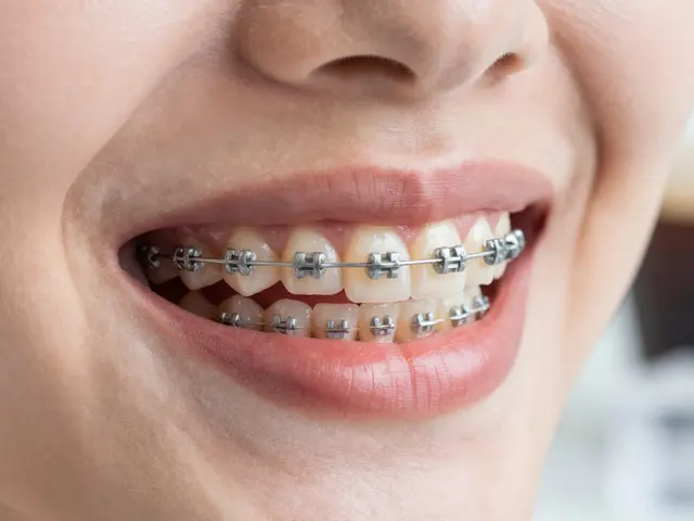 Keramické rovnátka: Jaké jsou možnosti pro citlivé zuby